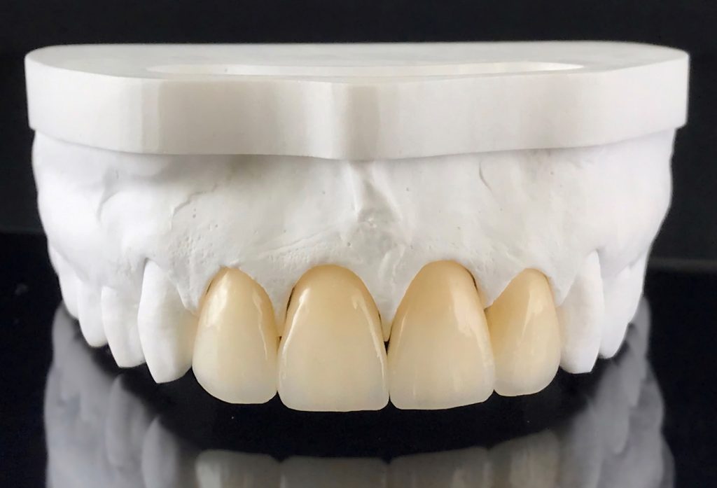 Zirconia crowns with full porcelain in the plaster model for dental treatment.
